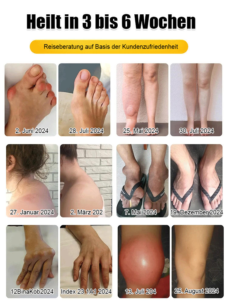 Bienengift schmerzlindernde Knochenheilungskreme