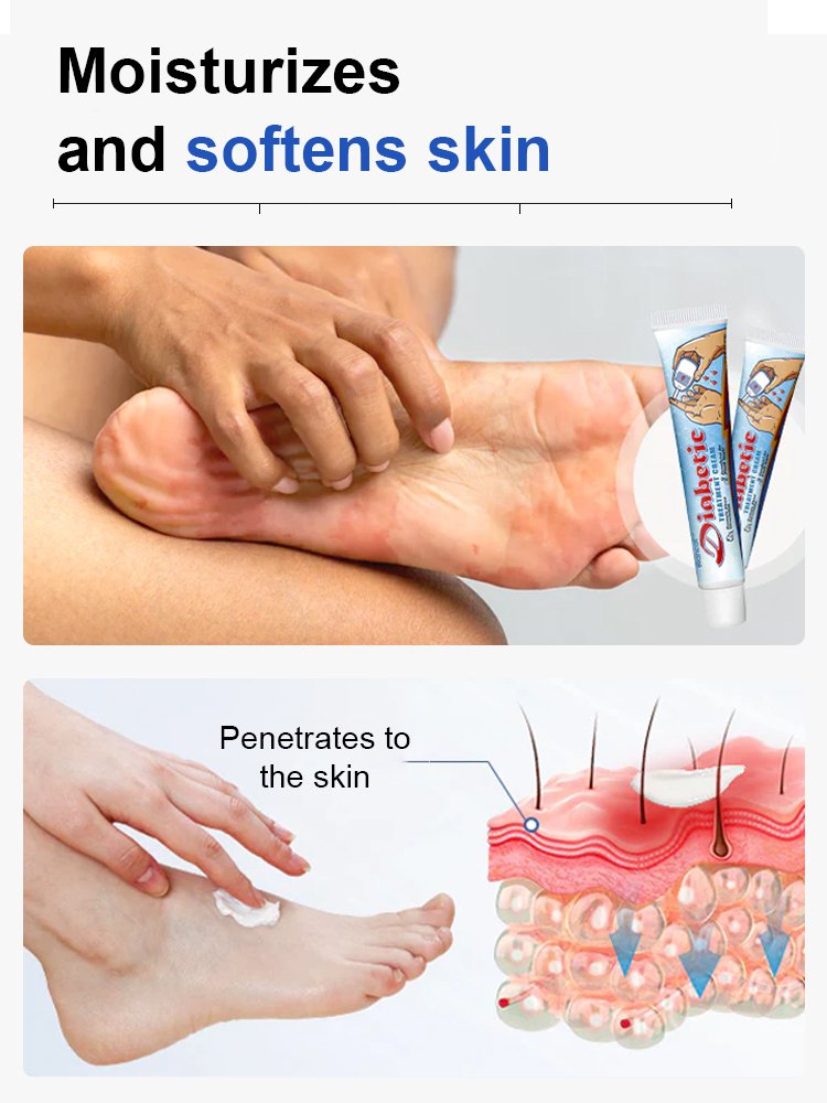 Diabetes Treatment Cream