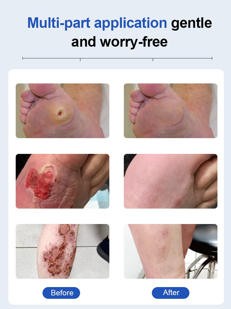 Diabetes Treatment Cream