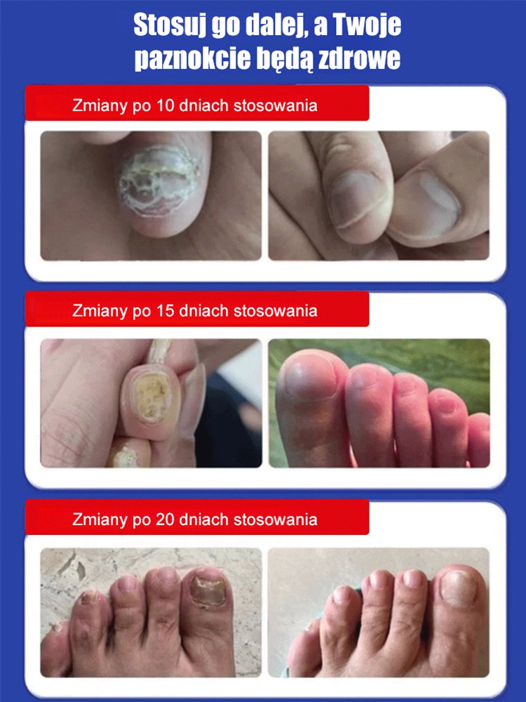 Ziołowy krem do naprawy paznokci dla paronycji