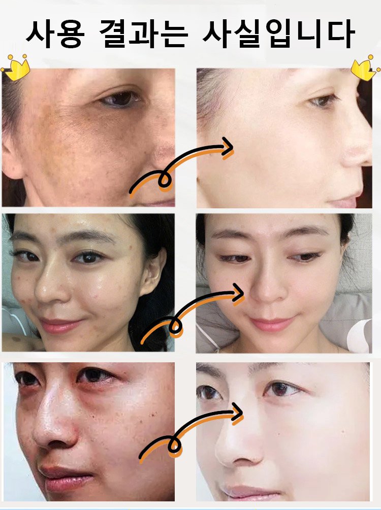 【반점을 한 번에 제거】반점 완화 요소 크림