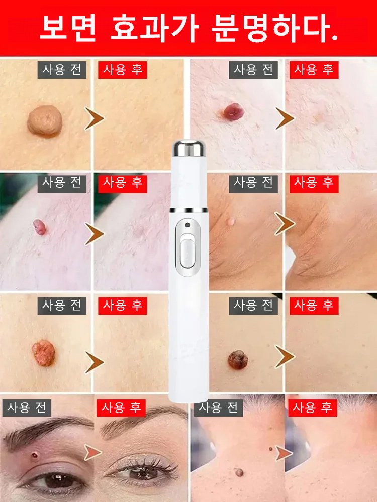 레이저 무통 사마귀 제거 펜