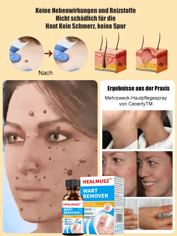 Körperpflege Warzenentfernungslösung