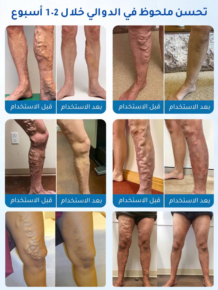 سائل العناية لتخفيف الدوالي والتورم