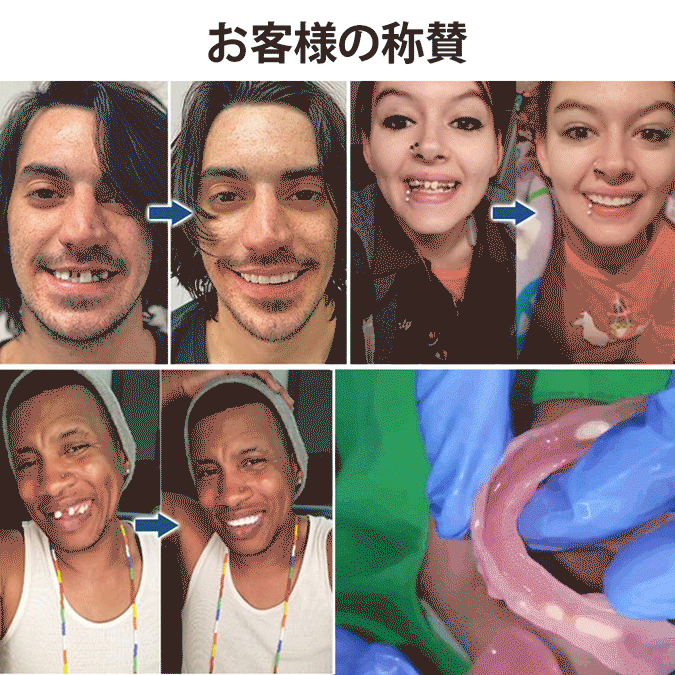 ワンタッチ付け歯