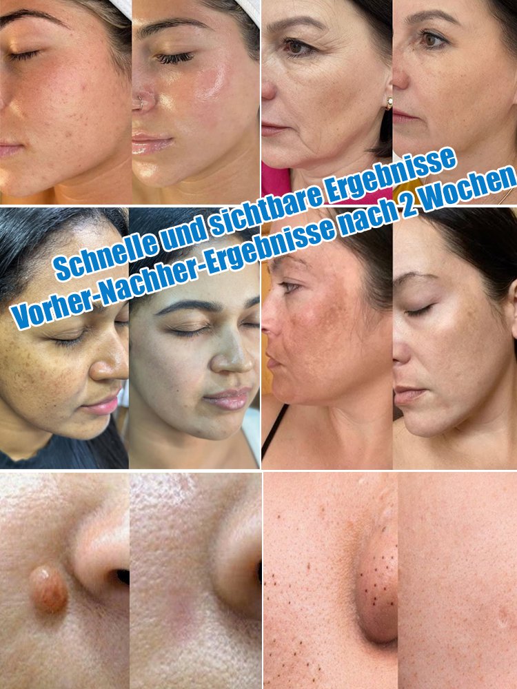 Laser-Schönheitsgerät