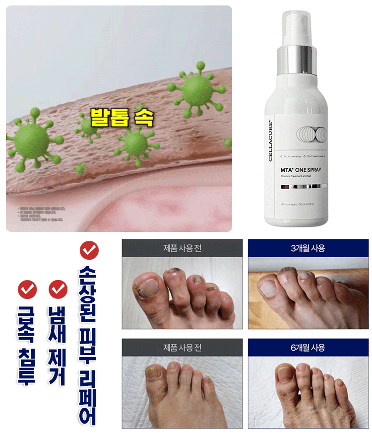 발 진균 관리 스프레이