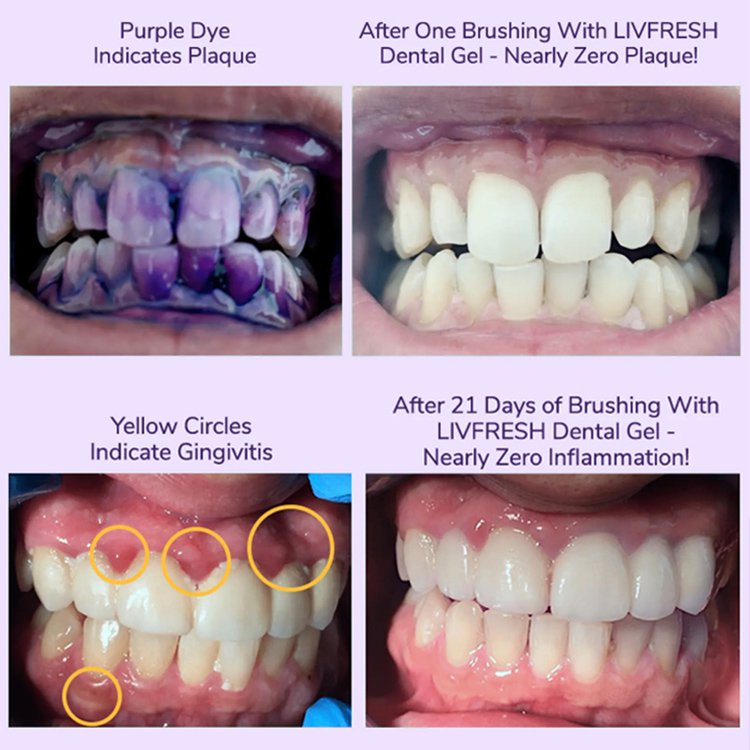 【Removes 250% of dental plaque】Color Correcting Whitening Toothpaste