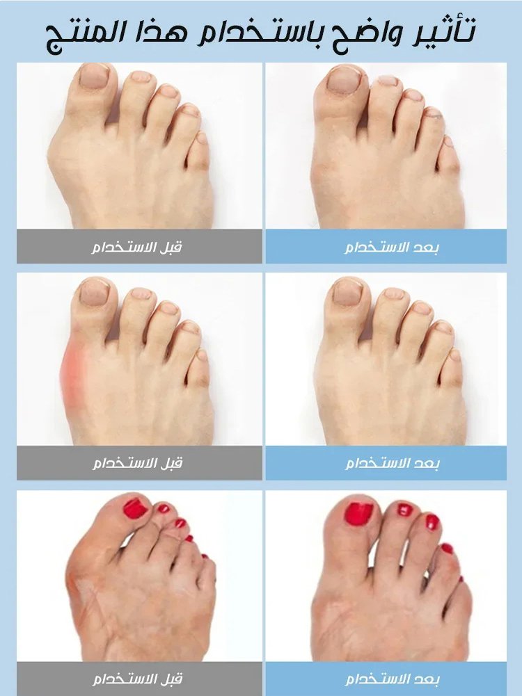 【براءة اختراع ألمانية】شبشب لتصحيح انحراف إبهام القدم