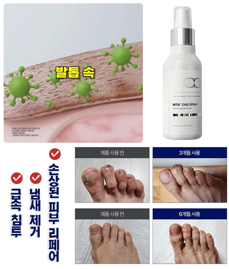 발 진균 관리 스프레이