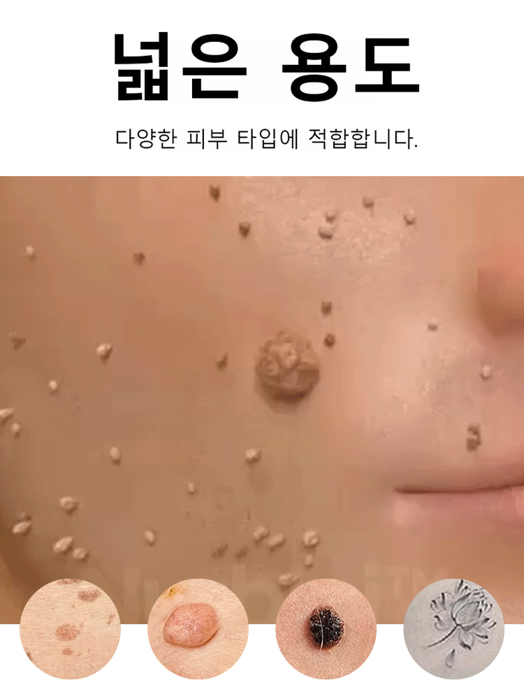 레이저 무통 사마귀 제거 펜