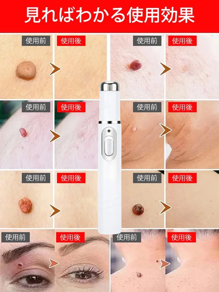 レーザーイボ取り美顔ペン