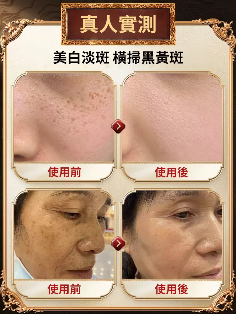 【專攻頑固斑點】美白強效祛斑霜濃縮版