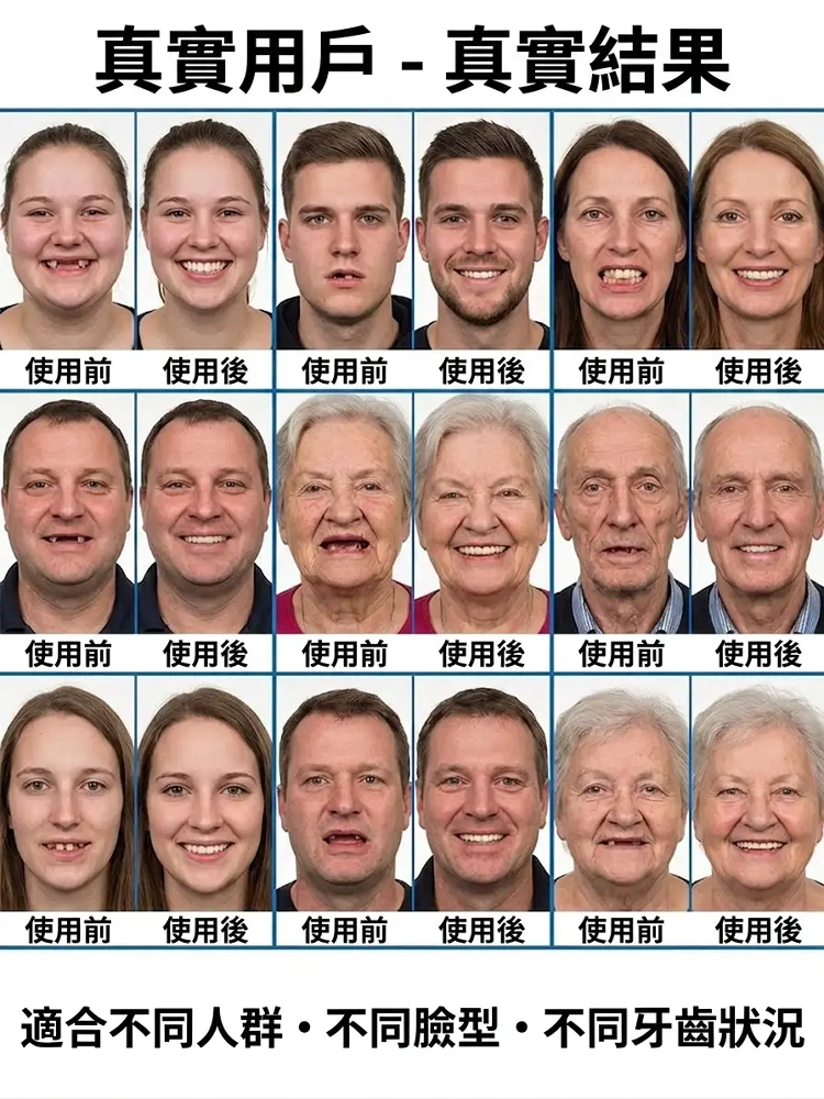 【完美貼合臉型】自適應全包假牙套