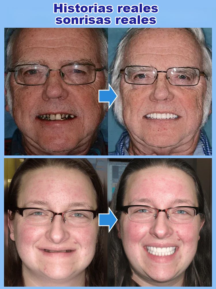 Set de prótesis dentales de soporte esquelético total