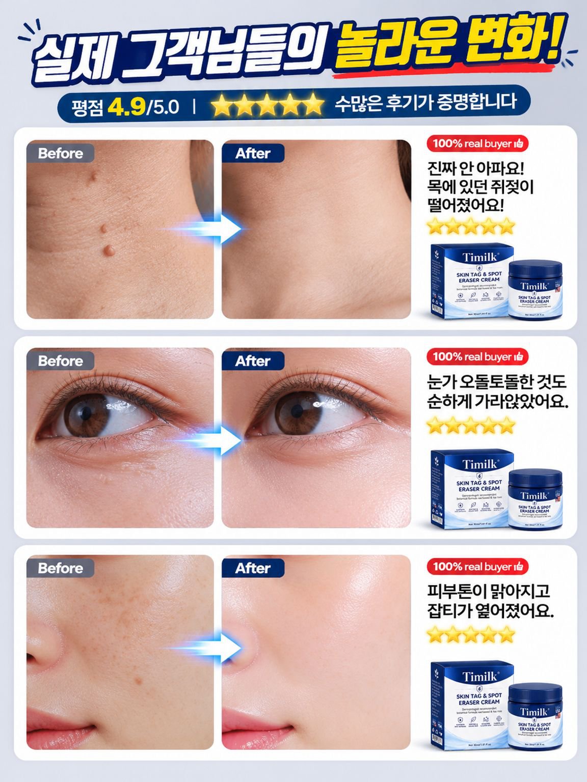 7일 피부 사마귀 제거 크림