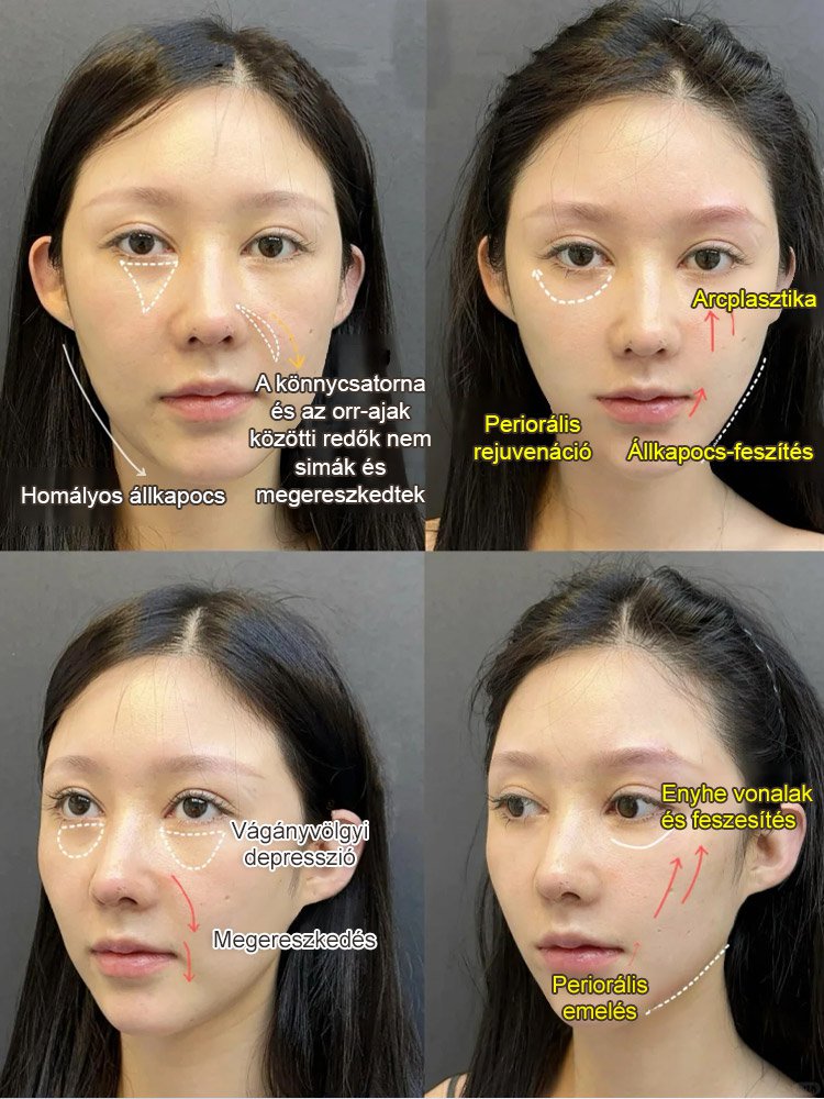 【Ránctalanító NO.1】Arany hexapeptid feszesítő esszencia