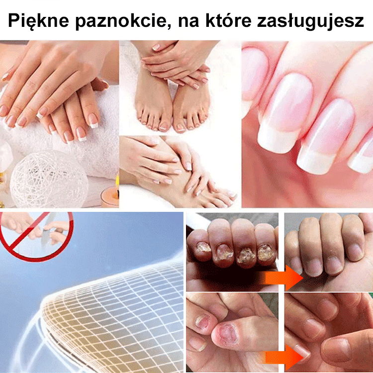 [Bezbolesne i bez nawrotów] Maść na grzybicę paznokci