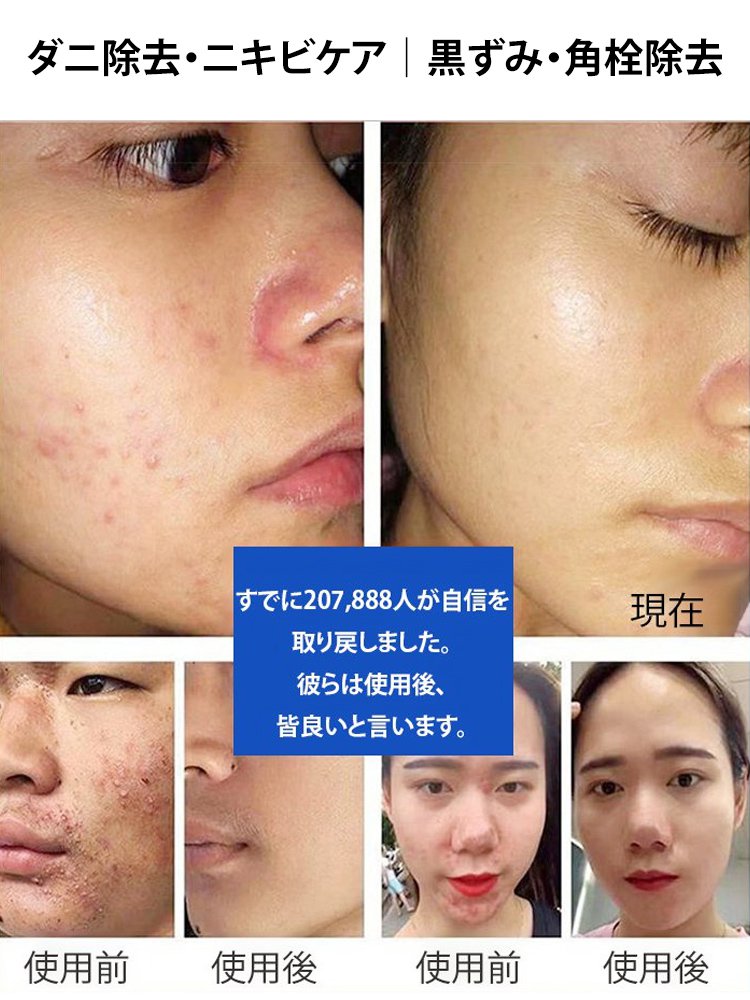 【ニキビと吹き出物のケア】サリチル酸配合美白ボディウォッシュ