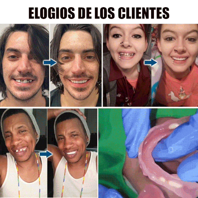 Conjunto de carillas cosméticas para dientes.