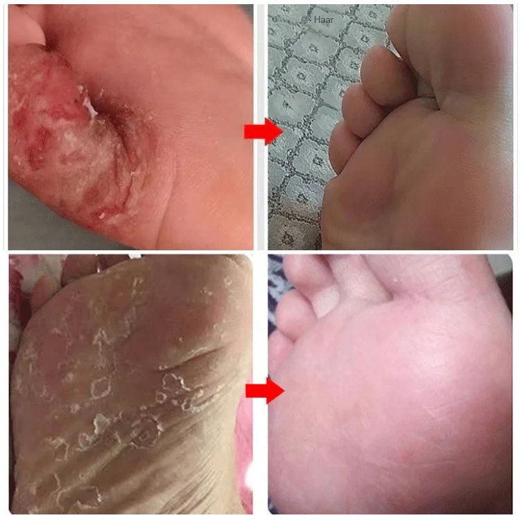 Medizinisches Chitosan Fußentspannungsspray