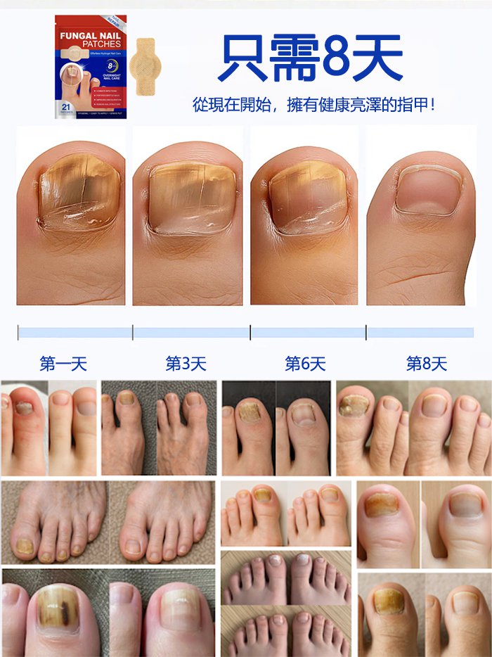 指甲修護矯正抑菌貼