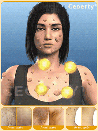 Solution pour éliminer les verrues corporelles