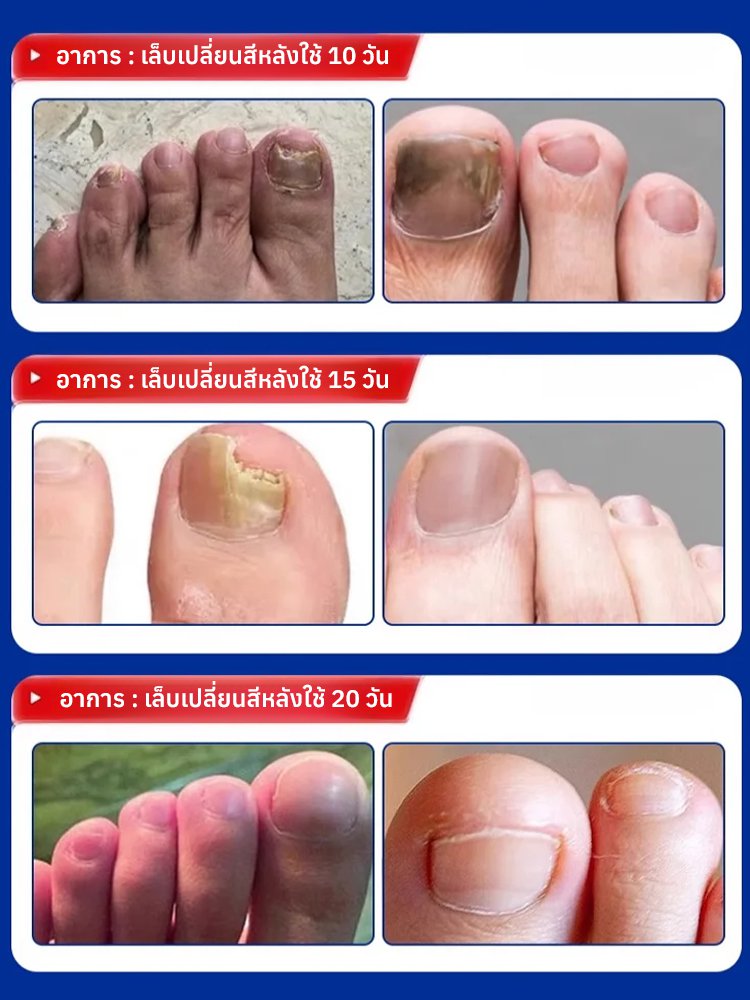 ✅ได้รับการรับรองจาก อย-น้ำยาบำรุงเล็บ