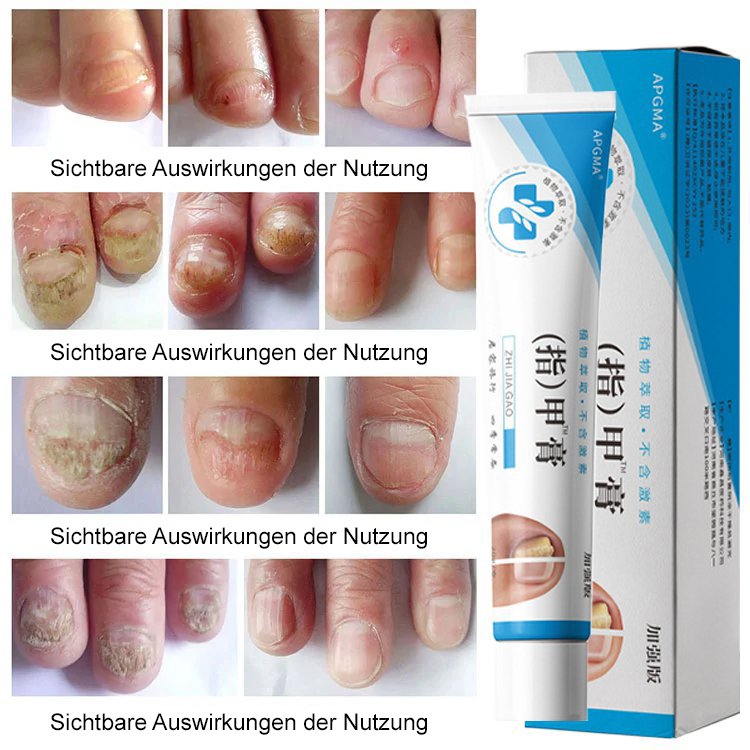 [Schmerzlos und kein Wiederauftreten] Onychomykosesalbe