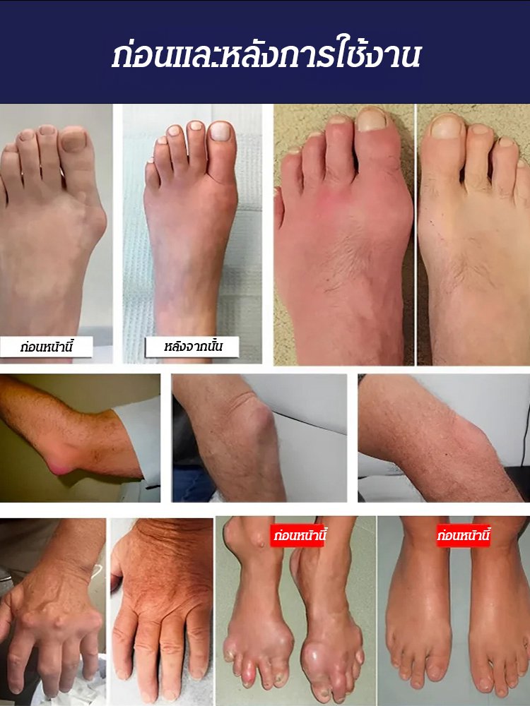 【ข้อต่อไม่เจ็บอีกต่อไป】อาหารเสริมบำรุงข้อต่อ