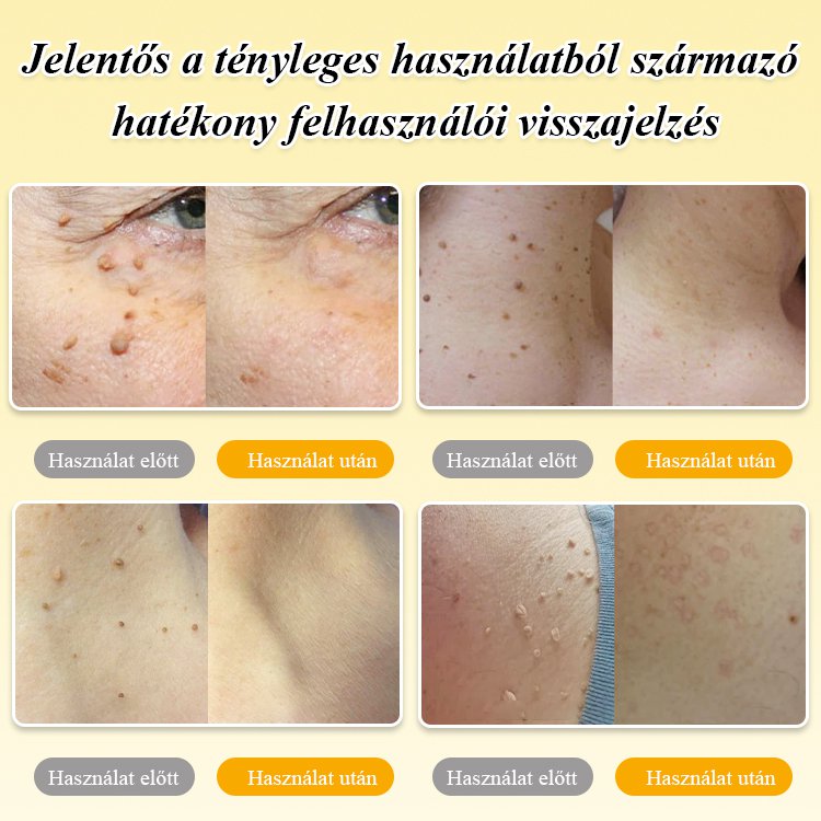  Bee Venom szemölcsök ápoló spray