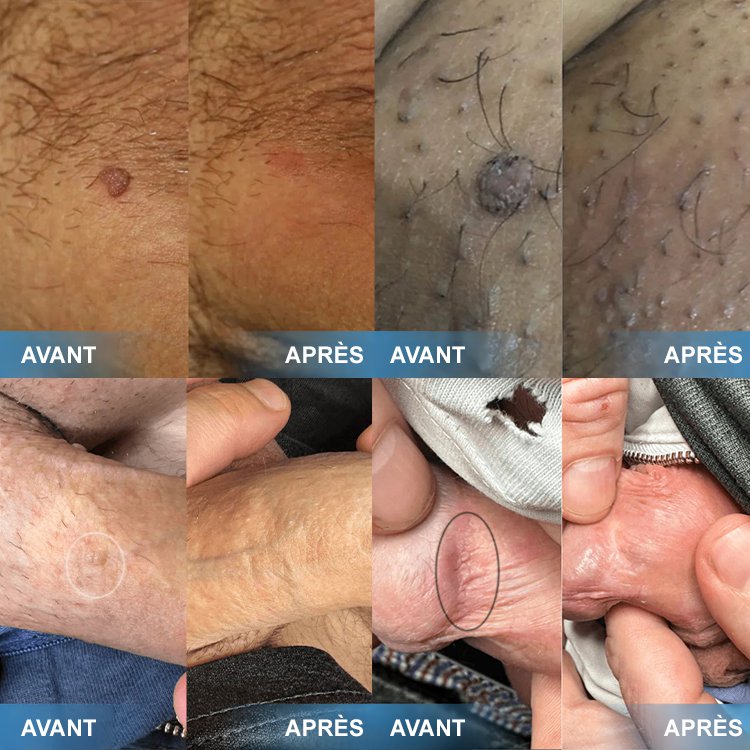 Crème pour l'élimination des verrues et l'adoucissement de la peau.