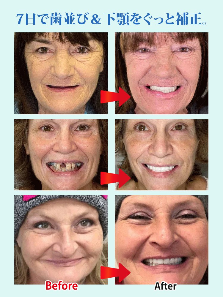 審美用マウスピース，スイス輸入品、口いっぱいのスイス製、そして高貴な身分の象徴！！