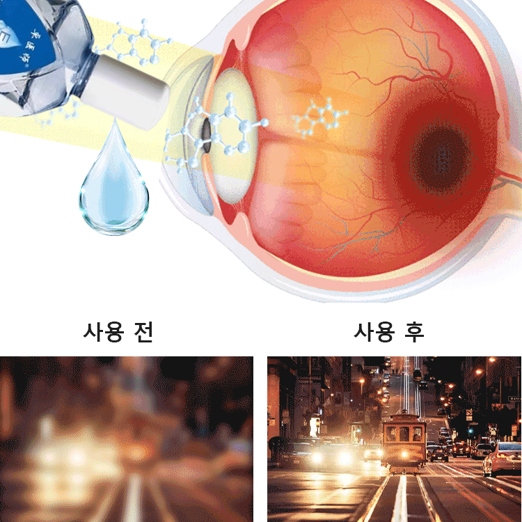 시력 교정 안약