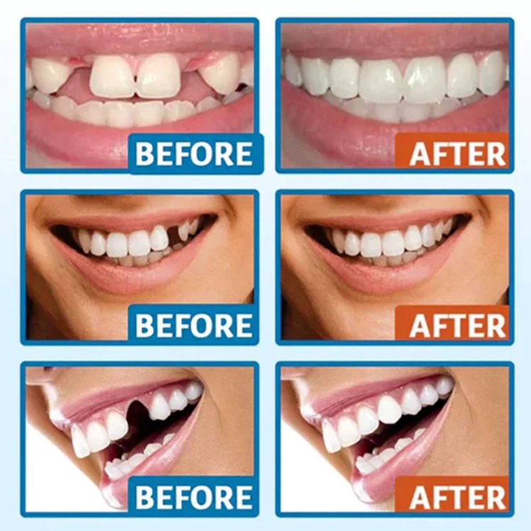 South Moon歯用接着剤