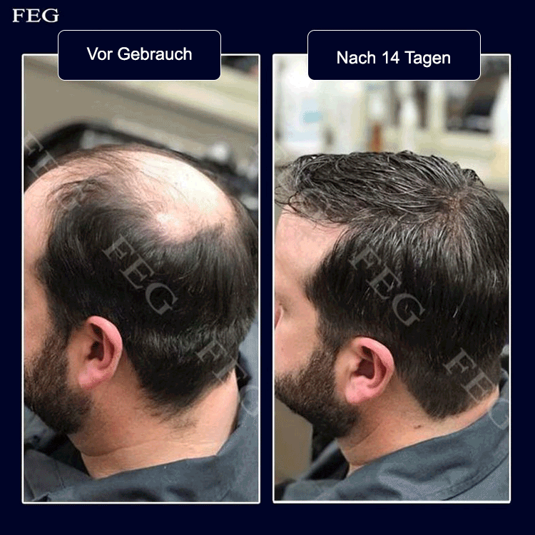FEG Haarwachstumsspray