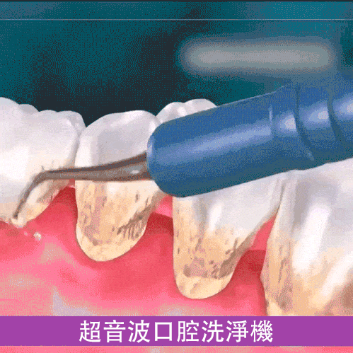 牙結石去除器