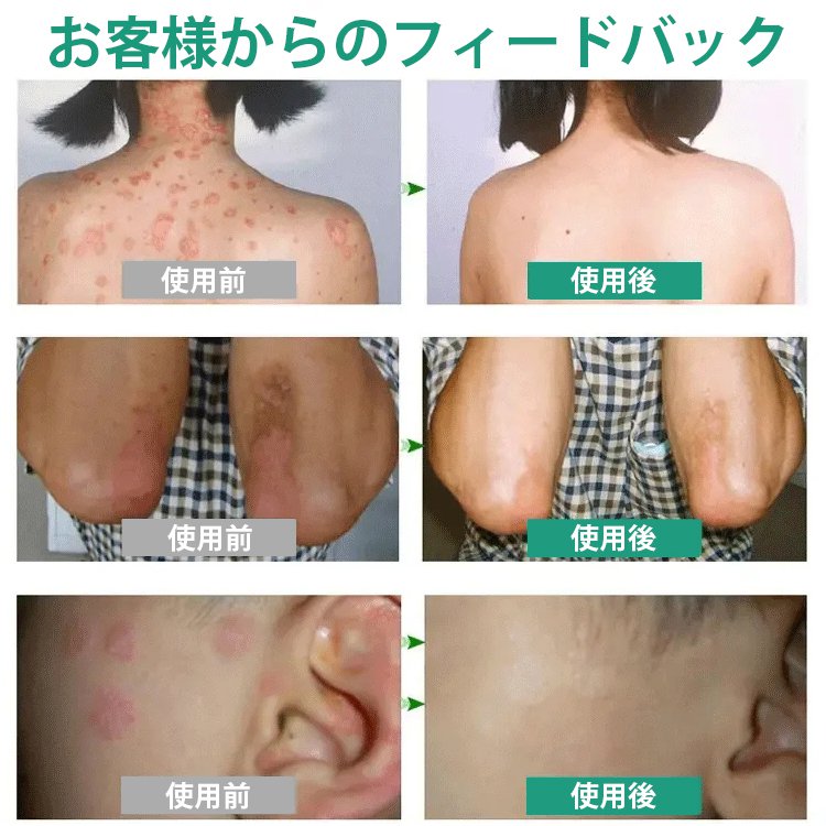 乾癬対策クリーム