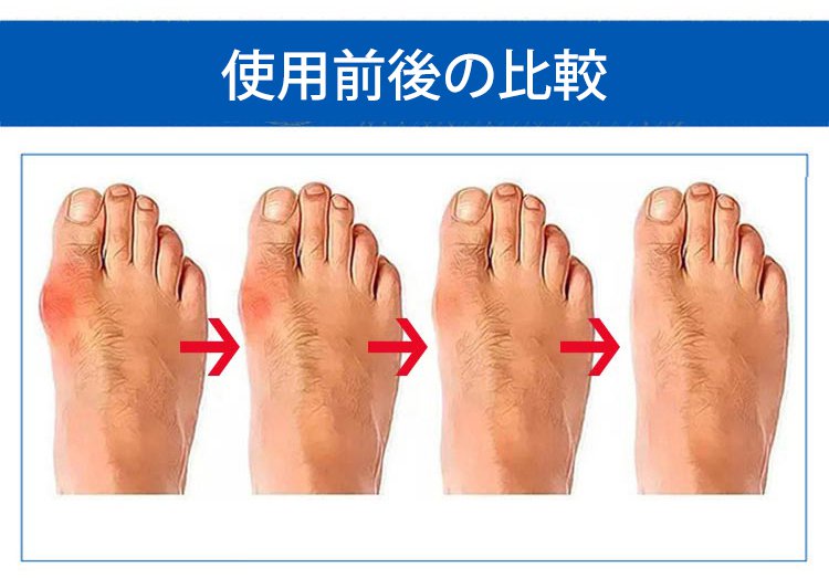最後の1時間は半額!【足の専門医が推薦】男女兼用矯正用5本指浅履きソックス、効果がなければ全額返金保証！ - detail 21