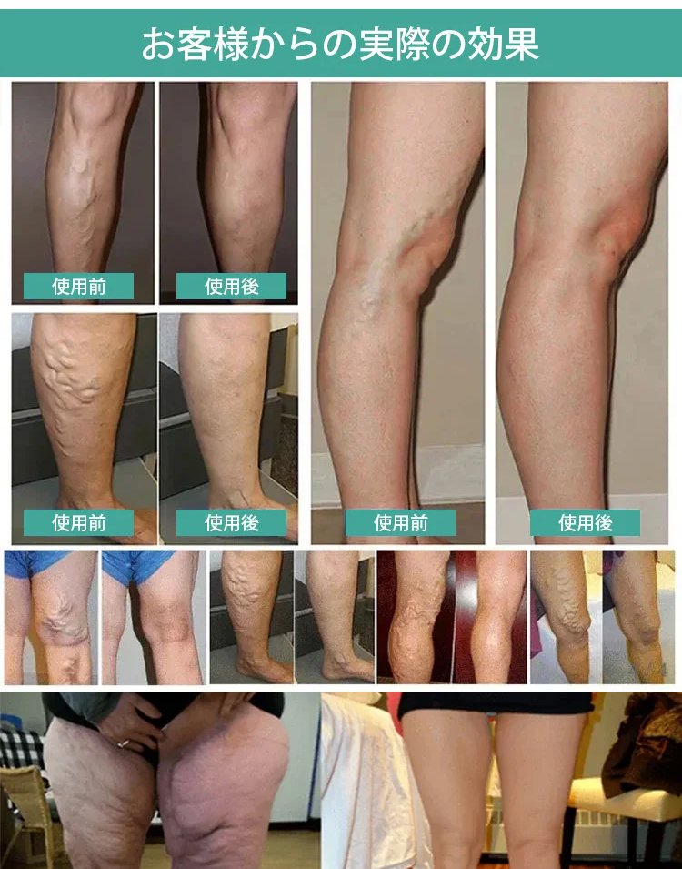 アイスシルク医療用インソール