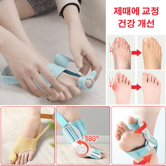 무지외반 교정기